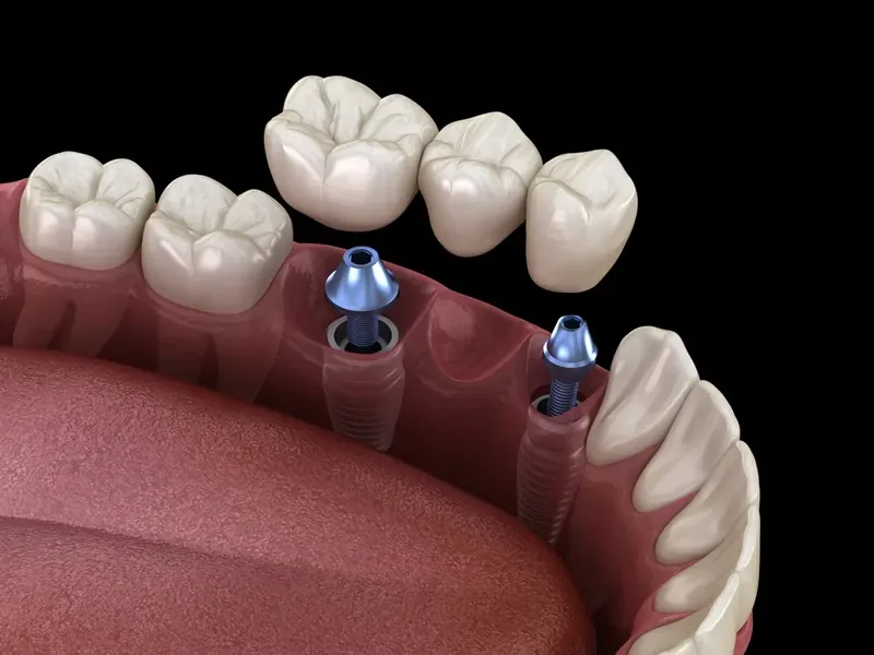 Illustration of a dental bridge anchored on implants