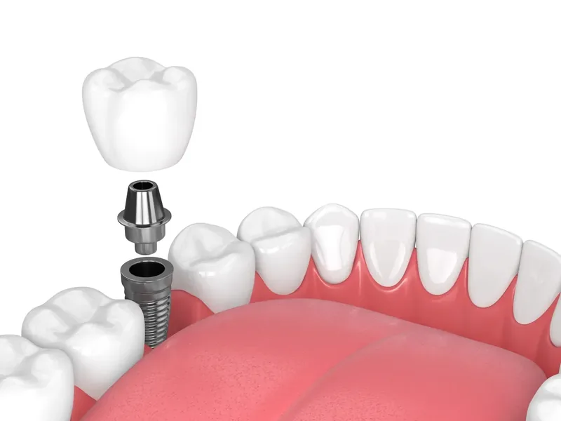 Illustration of a dental implant supporting a crown