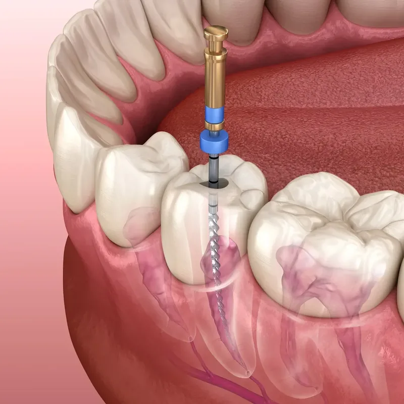 Illustration of a root canal treatment inside a molar